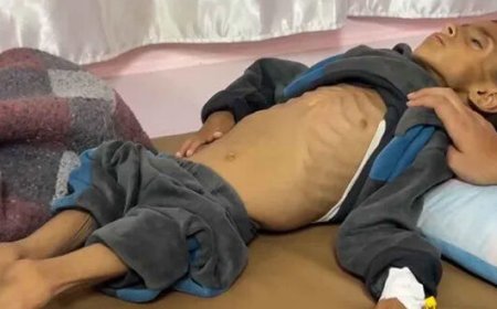 UNICEF: Más de 100 niños sufren desnutrición a diario en Gaza