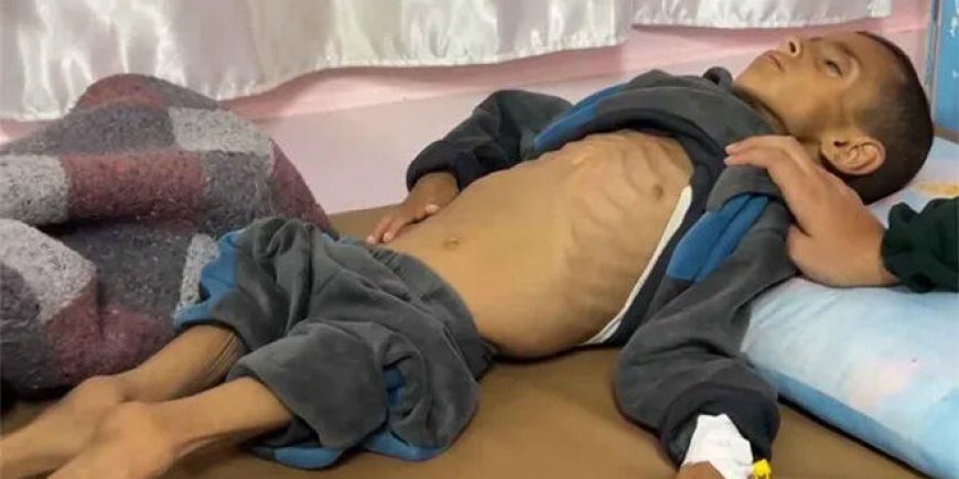 UNICEF: Más de 100 niños sufren desnutrición a diario en Gaza